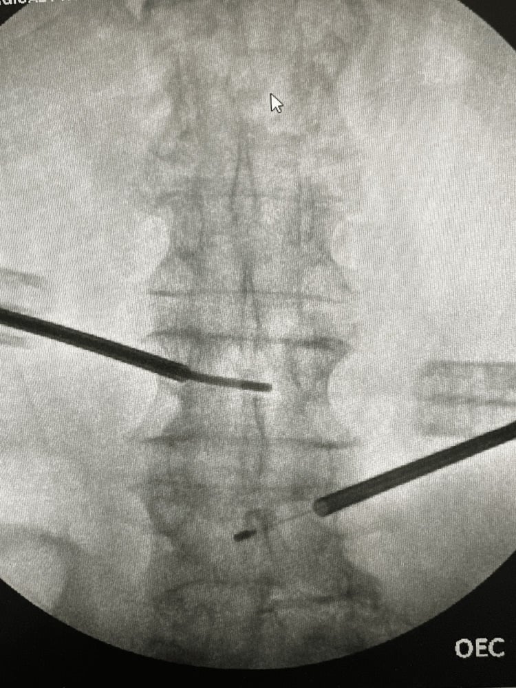 AP fluoroscopy showing transpedicular probes positioned for basivertebral nerve ablation