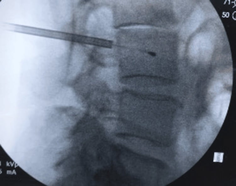 Lateral fluoroscopy showing the radiofrequency probe within the L3 vertebral body during basivertebral nerve ablation