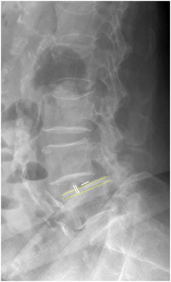 Lateral lumbar radiograph demonstrating the parallel-line method for measuring interbody cage subsidence