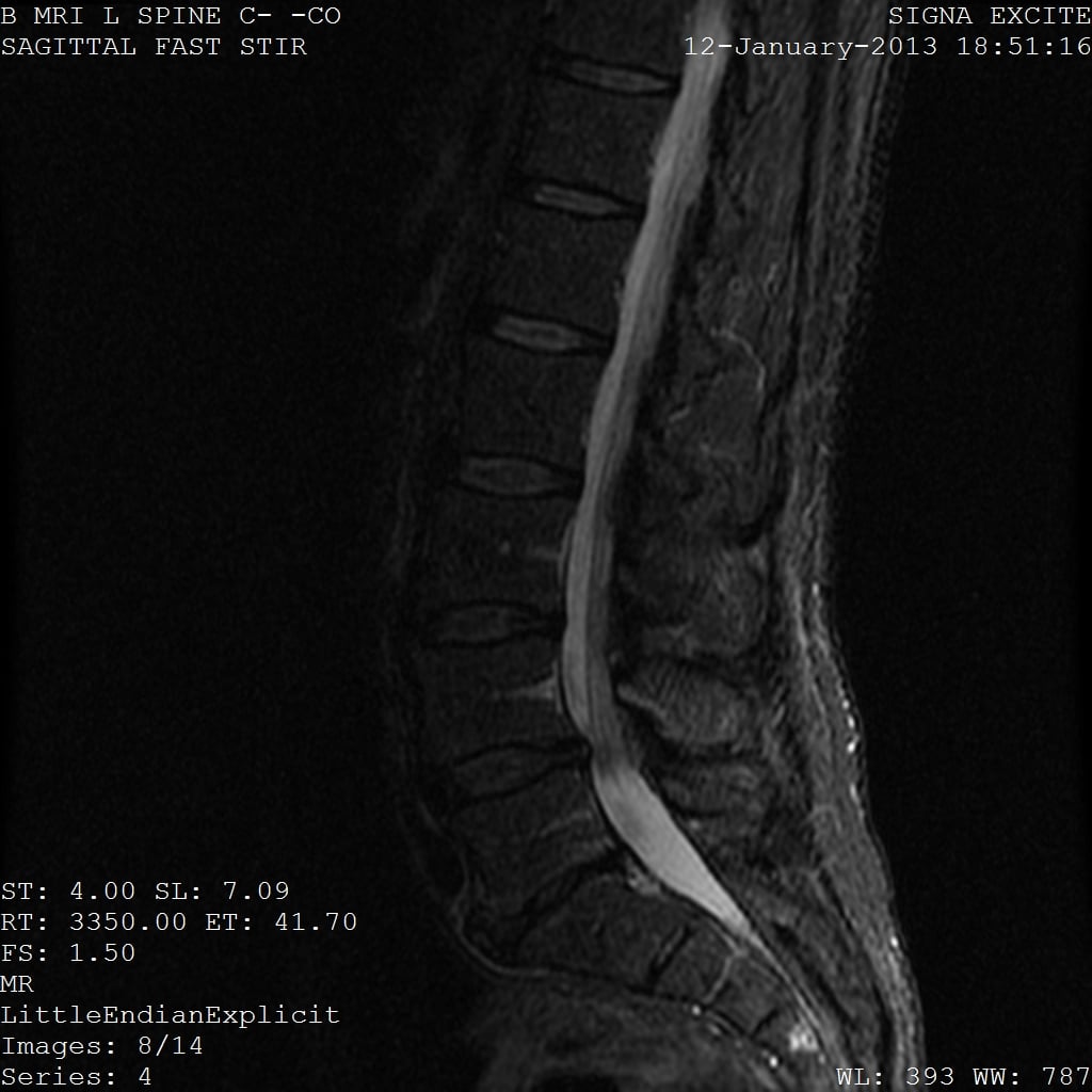 Sagittal STIR lumbar spine MRI showing multilevel degenerative disc disease