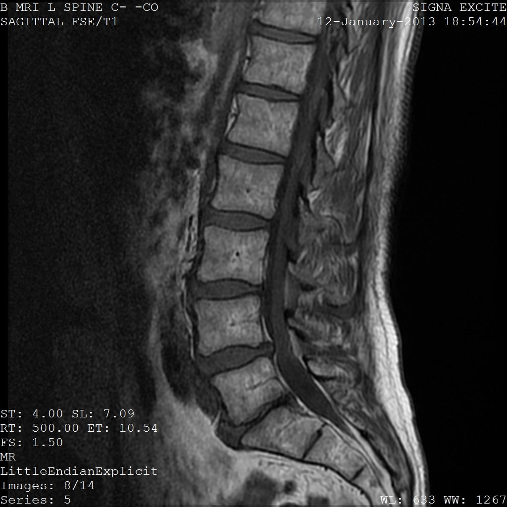 Sagittal T1 lumbar spine MRI of the same patient showing degenerative disc disease