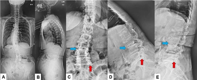 Whole-spine and lumbar radiographs showing L3-4 collapse, endplate change and dynamic angulation