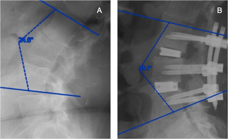 Preoperative and postoperative lateral radiographs after two-level lateral lumbar interbody fusion with posterior instrumentation