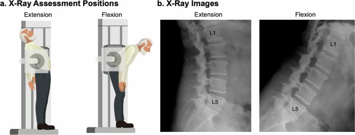 Standing extension and flexion radiographs illustrating load-dependent change in lumbar disc height and wedge angle
