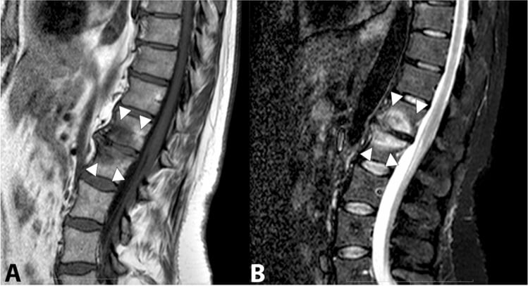 Sagittal T1 and STIR lumbar MRI showing Modic type 1 fibrovascular endplate marrow change