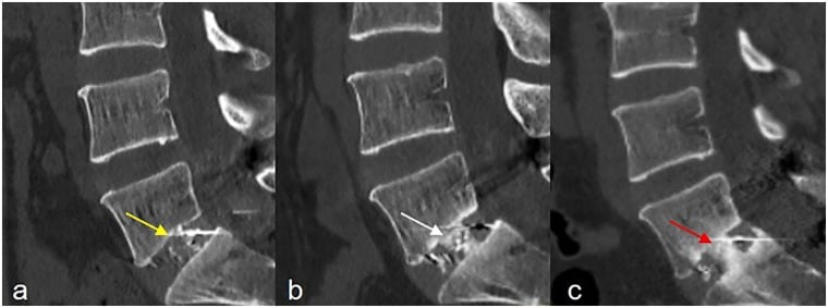 Sagittal CT examples of modified Bridwell-Suk fusion grades from pseudarthrosis to solid interbody fusion