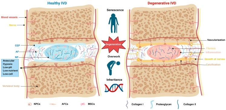 Schematic comparing a healthy intervertebral disc with a degenerate disc showing matrix loss, fibrosis, neovascularisation and nerve ingrowth