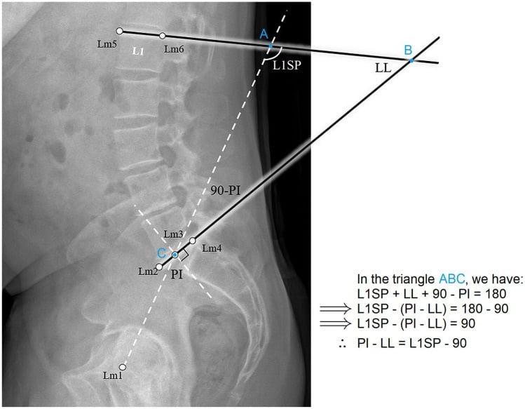 Lateral lumbar radiograph and geometric construction for measuring pelvic incidence and lumbar lordosis mismatch
