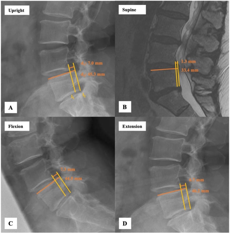 Upright, supine, flexion and extension lumbar images showing position-dependent L4-5 sagittal translation
