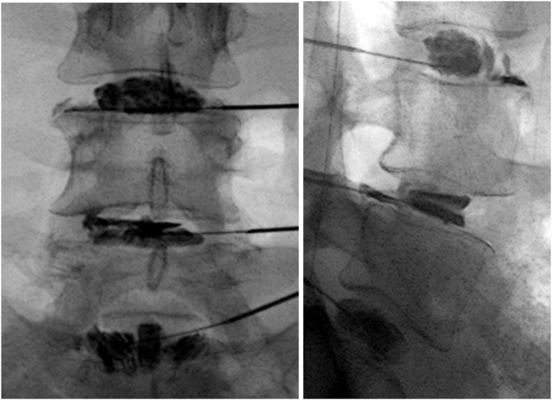 AP and lateral fluoroscopic provocation discography at L3-4, L4-5 and L5-S1 with a concordant painful L4-5 level