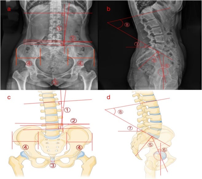 Standing AP and lateral radiographs with diagrams showing lumbar and spinopelvic measurement landmarks