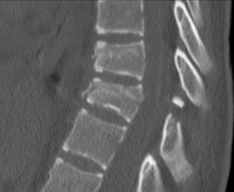 Sagittal CT of a Chance (flexion-distraction) fracture showing a horizontal tension failure through the vertebral body and posterior elements.