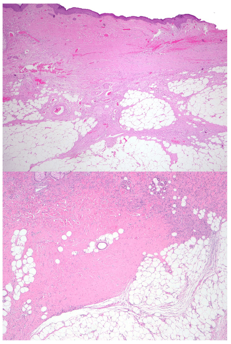 Histological response of DFSP to neoadjuvant imatinib