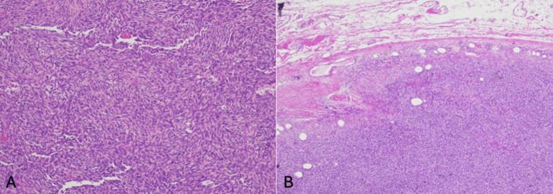 DFSP histology showing storiform spindle cells and honeycomb fat infiltration