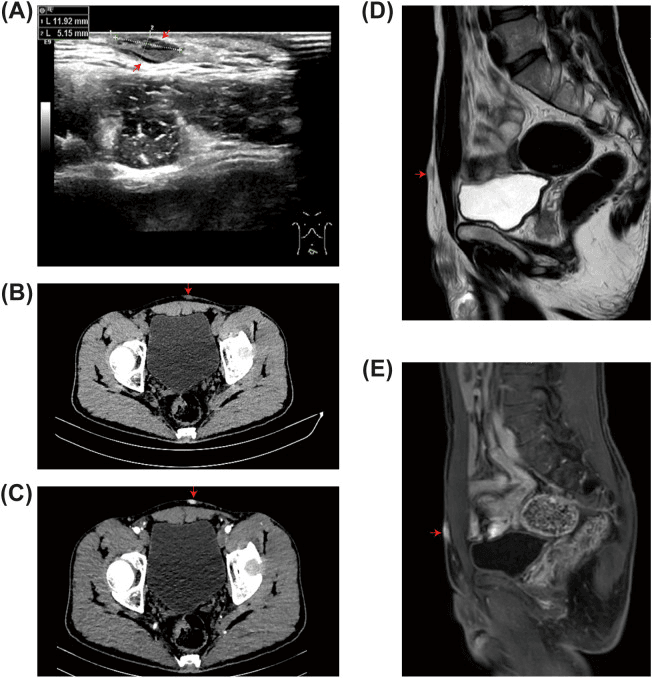 Ultrasound CT and MRI assessment of DFSP extent