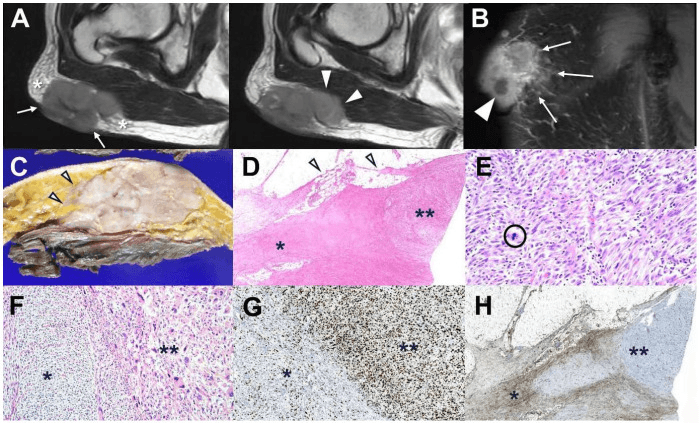 MRI and histology of fibrosarcomatous transformation in DFSP