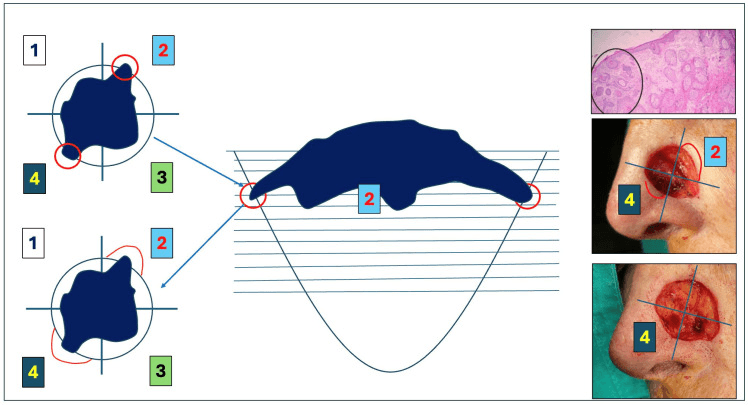 Targeted re-excision of an involved Mohs margin