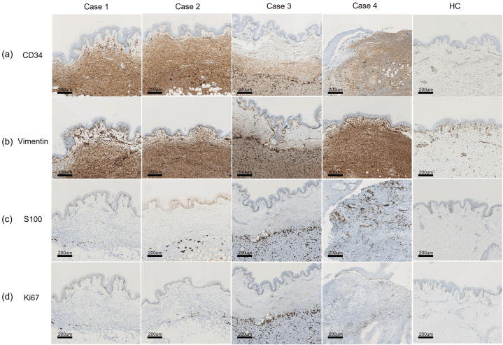 Immunohistochemistry of atrophic pigmented DFSP