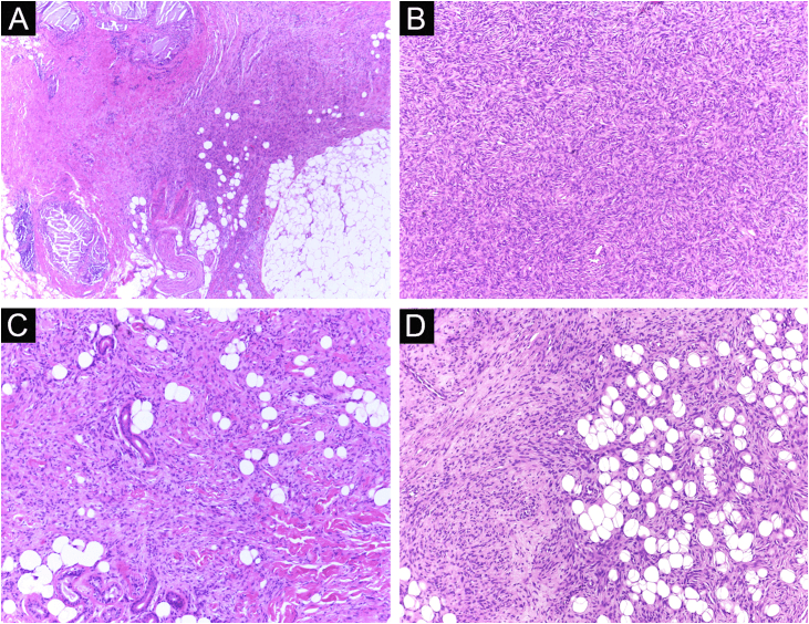 Recurrent DFSP invading hypodermis with storiform and honeycomb architecture