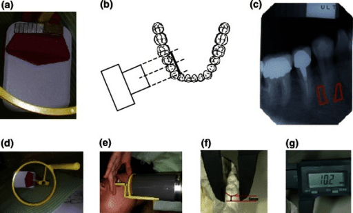 DXA scan showing bone density measurement of the lumbar spine with T-score and Z-score results
