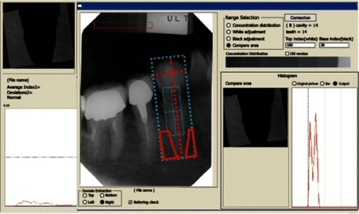 DXA scan of the proximal femur showing hip bone density measurement