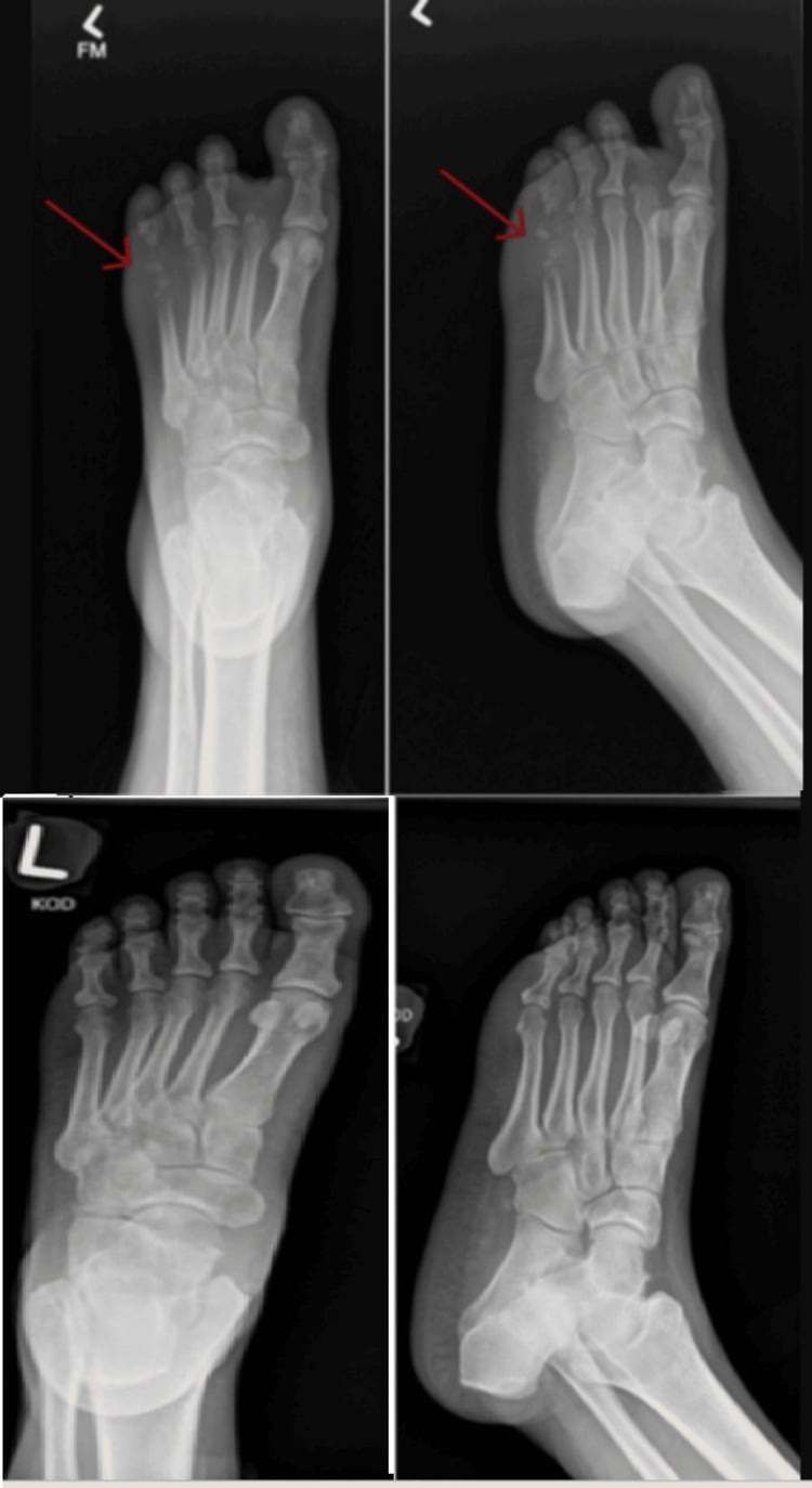 Radiographs of the foot showing osteolysis of the fifth metatarsal in diabetic foot osteomyelitis