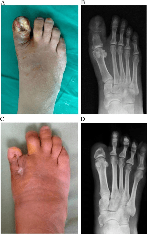Clinical and radiographic views before and after partial hallux amputation for diabetic foot gangrene