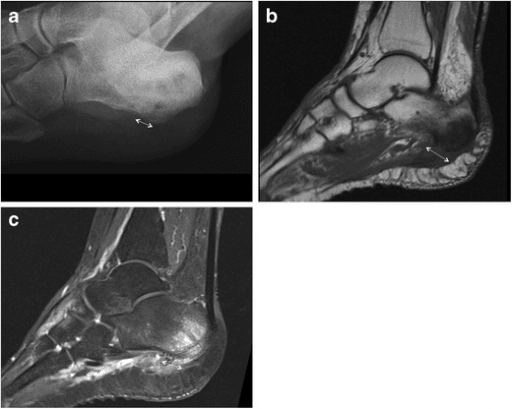 Lateral radiograph and sagittal MRI demonstrating calcaneal osteomyelitis