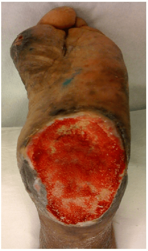 Plantar heel ulcer with extensive granulation tissue in diabetic foot osteomyelitis