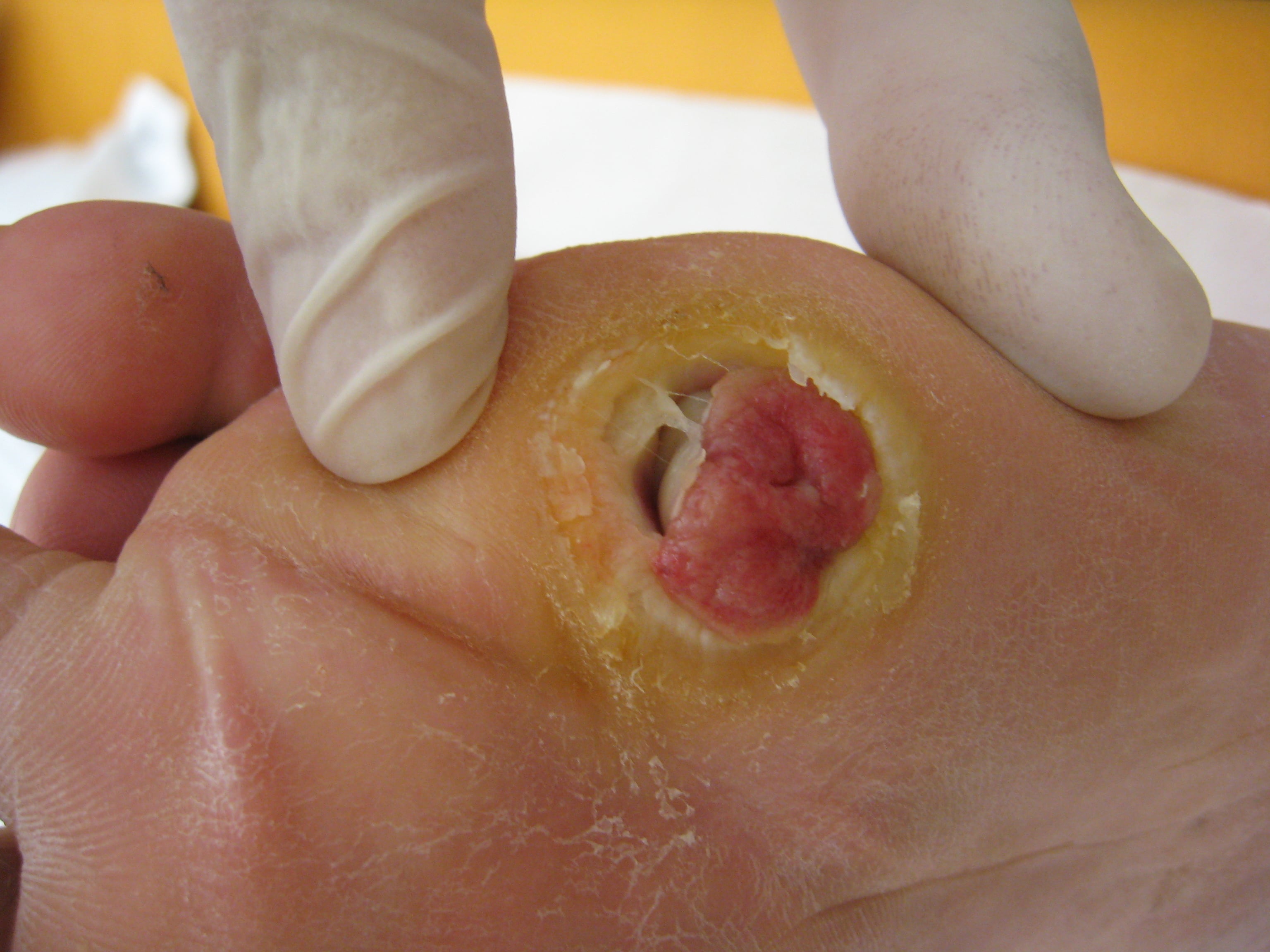 Plantar neuropathic diabetic foot ulcer with a hyperkeratotic rim and a granulating base.