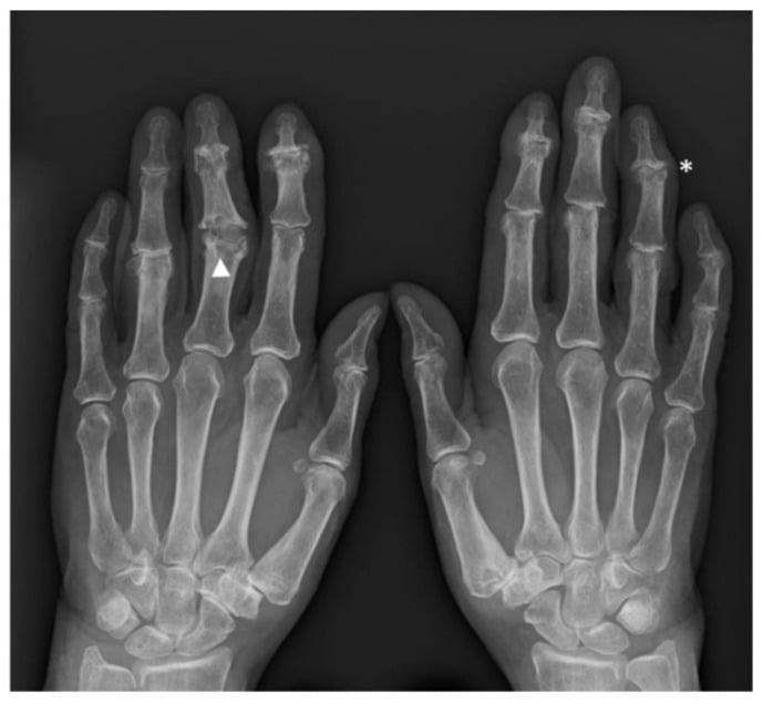 Bilateral hand radiographs of erosive osteoarthritis of the finger interphalangeal joints