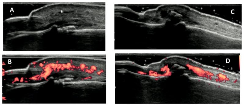 Greyscale and power Doppler ultrasound comparing DIP psoriatic arthritis with osteoarthritis