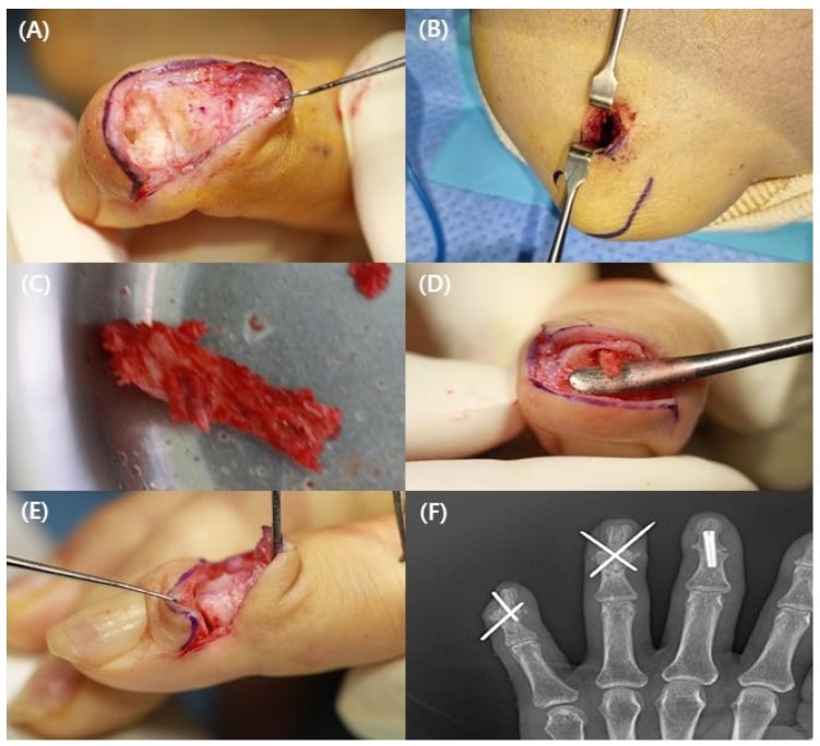 Six-panel operative sequence of DIP joint exposure, bone graft harvest and graft placement, with a radiograph of K-wire and screw fixation