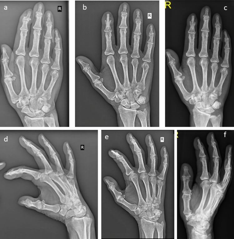 Serial radiographs of one right hand before and after DIP arthrodesis, panels a to f, frontal views above and a second projection below