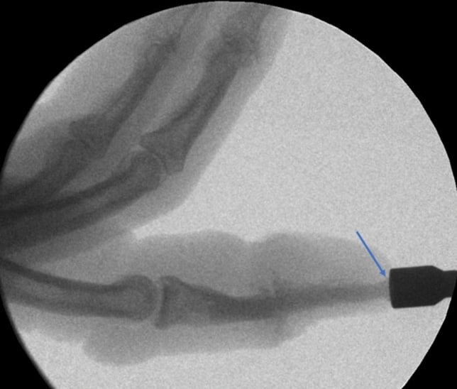 Intraoperative fluoroscopy of an allogeneic cortical screw (per the source) being inserted across the DIP joint, with an insertion instrument at the fingertip, marked by a blue arrow