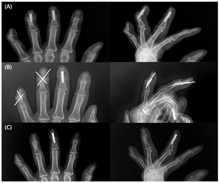 Three pairs of hand radiographs, A to C, showing DIP arthrodeses fixed with screws and with crossed K-wires