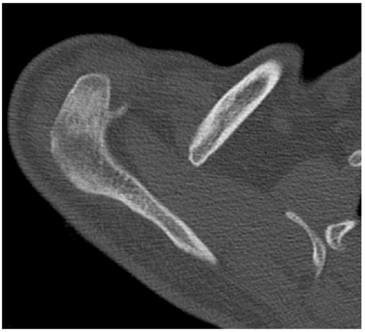 Axial CT through the acromioclavicular joint showing distal clavicle osteolysis