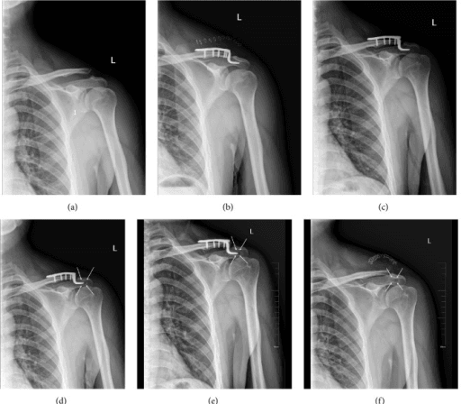 Serial radiographs showing subacromial osteolysis after clavicle hook plate fixation