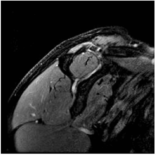Magnetic resonance imaging of the acromioclavicular joint in DP fat-suppression sequence demonstrating osteolysis