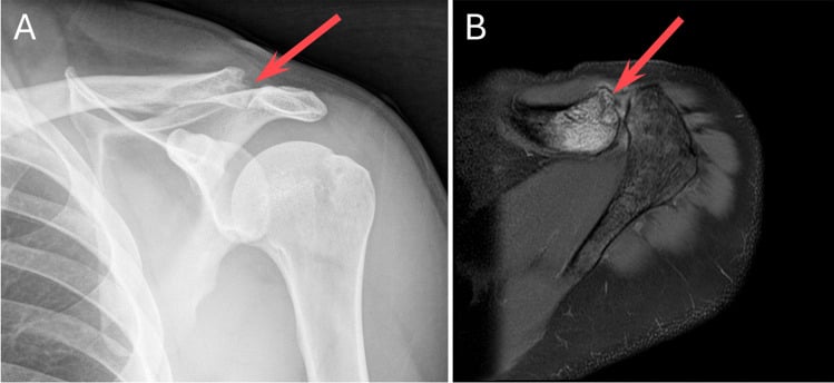 Externally rotated anteroposterior shoulder radiograph with axial MRI showing distal clavicular resorption