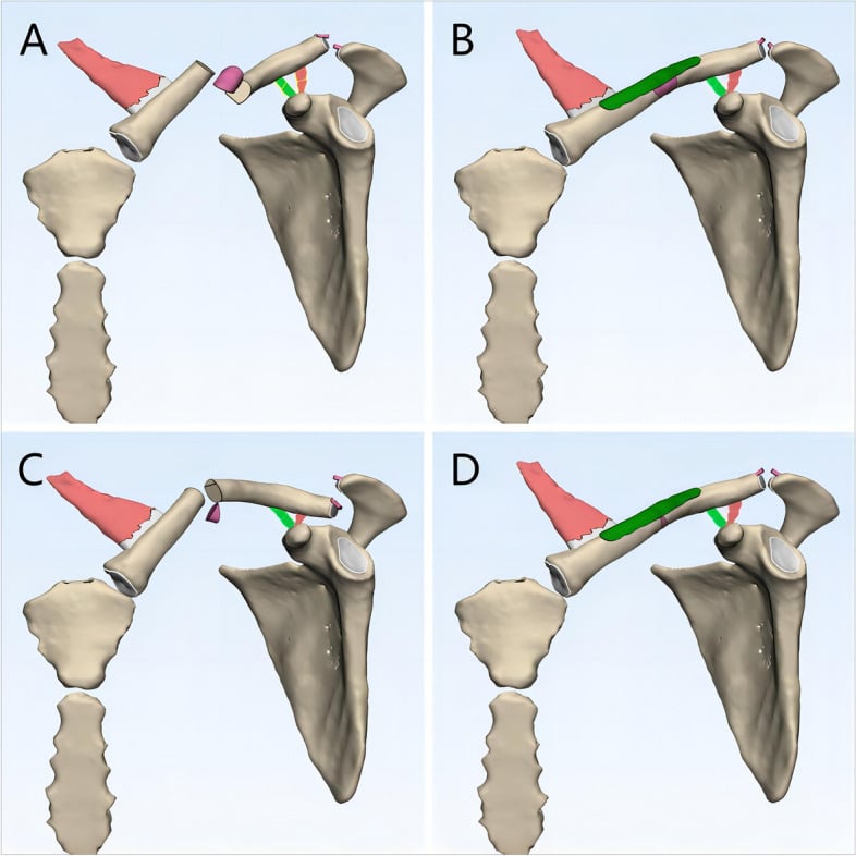 Illustration showing overestimation of acromioclavicular injury grade in the presence of an ipsilateral clavicle fracture