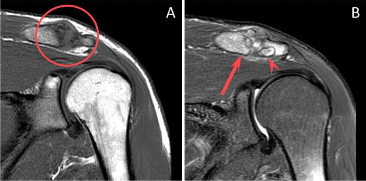 Coronal T1 MRI in a weightlifter showing osteolysis spanning the acromioclavicular joint