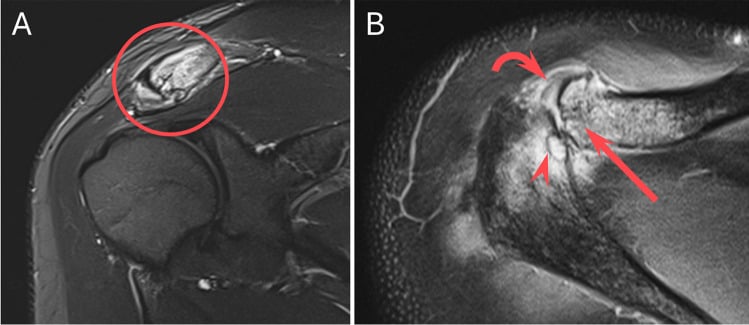 Coronal STIR MRI showing intense marrow oedema and distal clavicular resorption after trauma