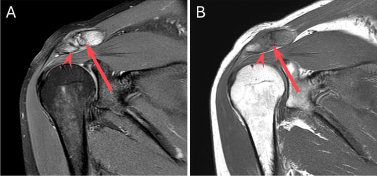 Coronal STIR and T1 MRI showing acute-on-chronic distal clavicular change from overuse
