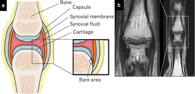 Illustration of a synovial joint showing the bare area between cartilage and capsular insertion