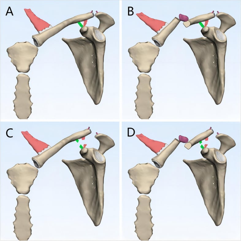 Diagram of the proposed mechanism of progressive acromioclavicular joint injury