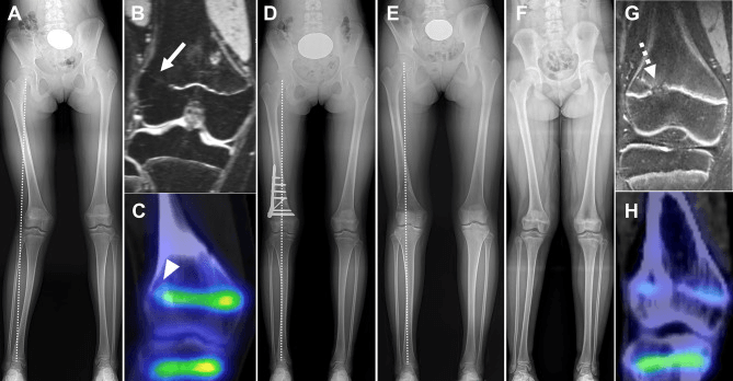 Long-leg radiographs, MRI and SPECT CT of a lateral distal femoral physeal bridge