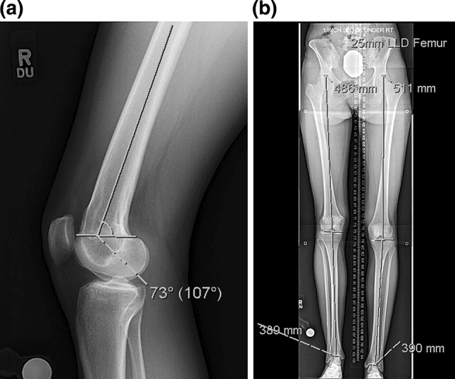 Lateral and standing long-leg radiographs of distal femoral flexion deformity and limb-length discrepancy