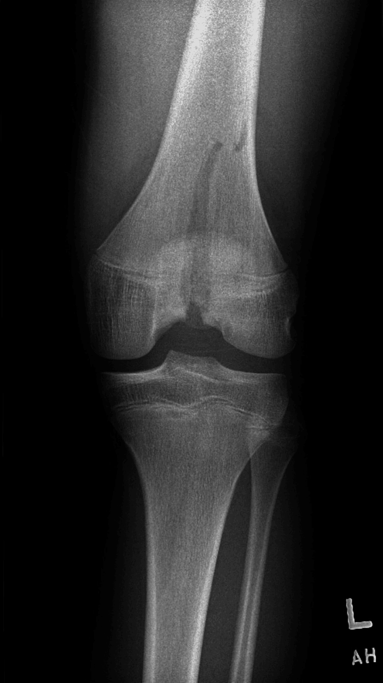 Anteroposterior radiograph of the left knee showing a distal femoral Salter-Harris type IV fracture