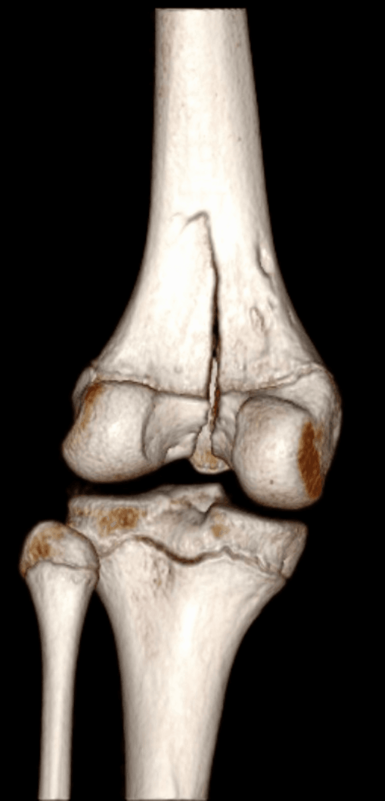 Posterior three-dimensional CT reconstruction of a distal femoral Salter-Harris type IV fracture